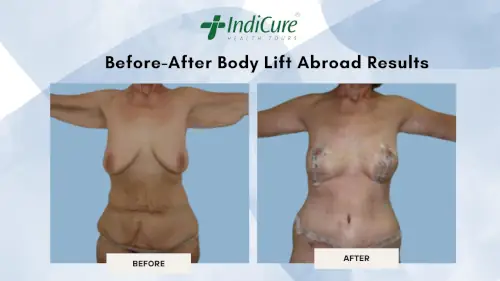 Before-After Body Lift Abroad Results